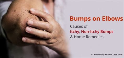 Don't panic though as most of the conditions responsible are harmless and resolve on their own given time. Bumps on Elbows: Causes of Itchy & Non-Itchy Bumps ...