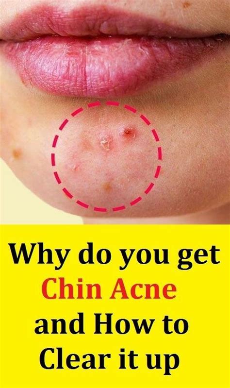 Pimples On The Chin What It Means And How To Get Rid Of Them Pimples
