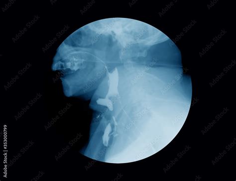 X Ray Image Of Barium Meal Examination Or Barium Swallow Upper