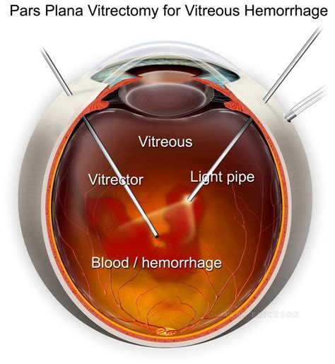 Pars Plana Vitrectomy Illustration Featuring Ppv On A Vitreous Hemorrhage