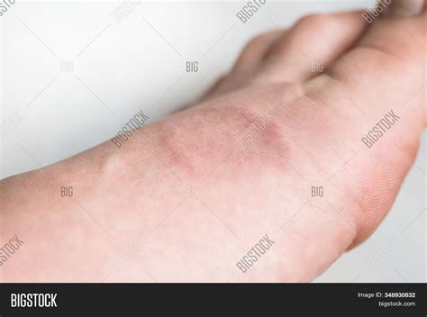 Human Leg Granuloma Image And Photo Free Trial Bigstock