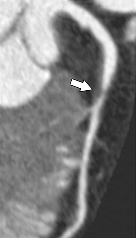 Ct Of Coronary Artery Disease Radiology