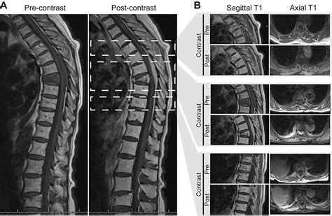 Cureus Spinal Lymphoma Presenting As An Epidural And Retropleural