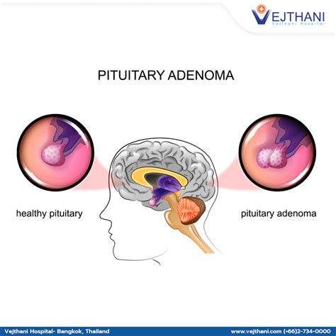Understanding Pituitary Adenomas Overview Of Symptoms Diagnosis And