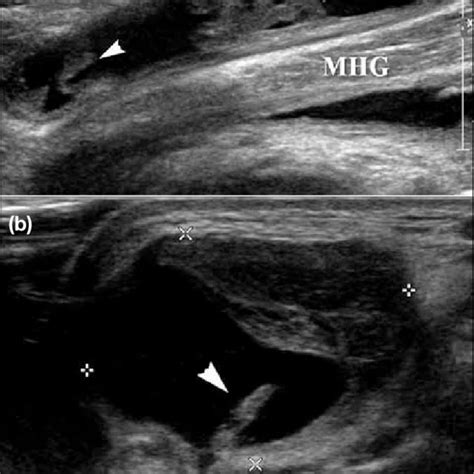 A Longitudinal Sonogram Shows A Thick Walled Bakers Cyst With