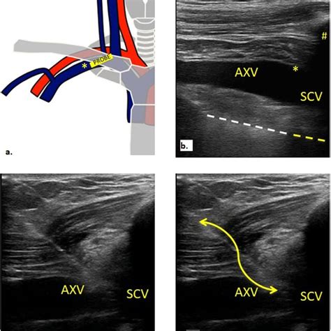 Ultrasound Guided Subclavian Cannulation Using In Plane Approach