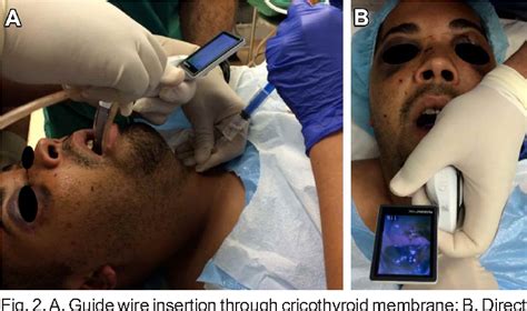 Figure 2 From Retrograde Submental Intubation Assisted With Direct