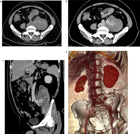 A Pre Contrast Ct Abdomen And Pelvis Axial Ct 4 Days After Initial