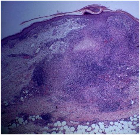 Granuloma Annulare Histopathology