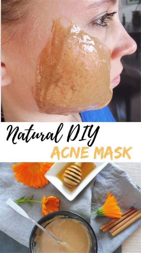 This Homemade Natural Facial Mask Designed Specifically For Acne Helps