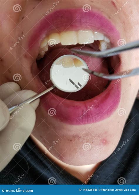 Face Of A Woman With Her Mouth Open For Oral Review And Hands Of A