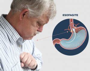 Inflamação do Esôfago a Esofagite Tipos Causas e Sintomas