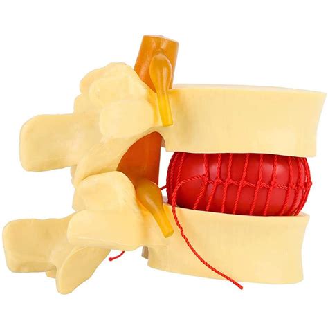 Buy Anatomical Human Spine Lumbar Vertebrae Degenerative Lumbar Disc