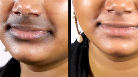 How To Remove Dark Black Patches Around Mouth In Tamil Youtube