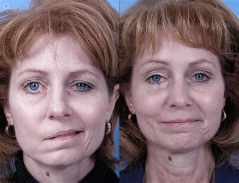Facial Paralysis A Guide To Bells Palsy
