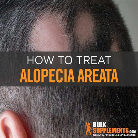 Alopecia Areata What Causes Male Pattern Baldness