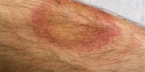 Tick Bite Pictures Symptoms Causes Treatment Hubpages Vrogue Co