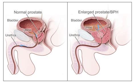 Understanding Prostate Changes National Cancer Institute