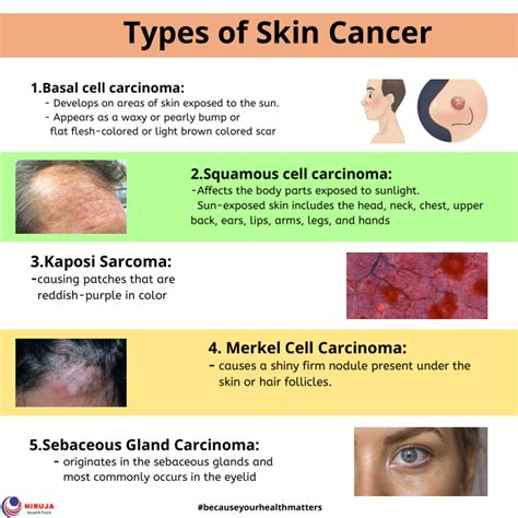 Types Of Skin Cancer Niruja Healthtech