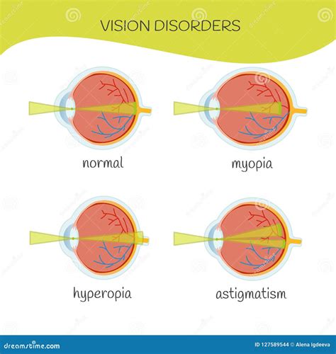 Infografica Eyes Disease Stock Vector Illustration Of Glasses 127589544