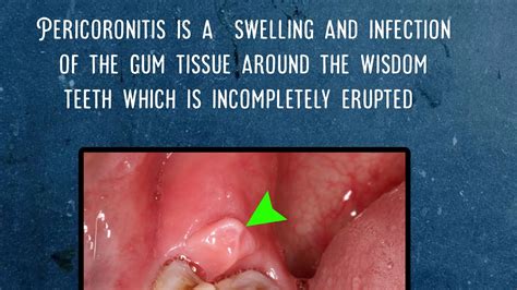 Pericoronitis Swollen Gum Around The Teeth Signs And Symptoms