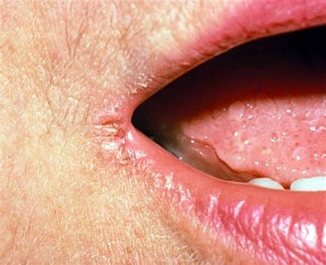 They can determine the cause of the lack of healing. 10 Best Home Remedies for Angular Cheilitis - Home Remedies