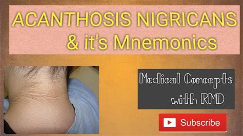 Acanthosis Nigricans And Its Mnemonics Youtube