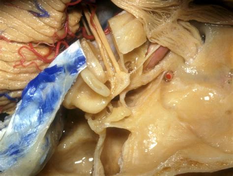 Post-Drilled View of Internal Auditory Canal and External, Middle, and
