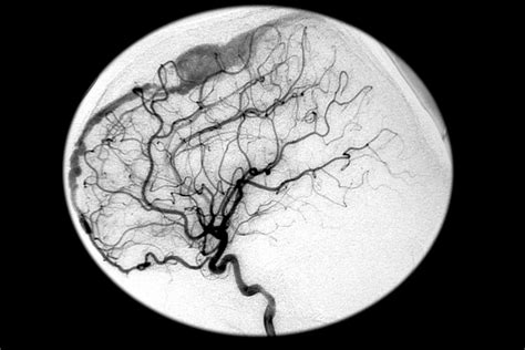 Site Of Dural Arteriovenous Fistula Linked To Clinical Features Of