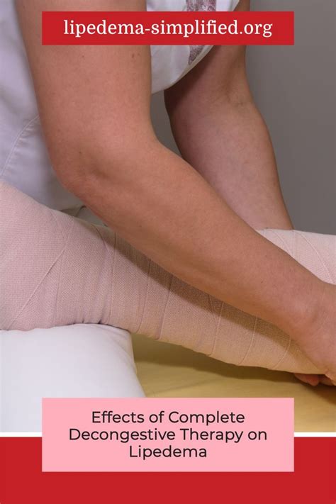 How Effective Of Complete Decongestive Therapy On Lipedema In 2021