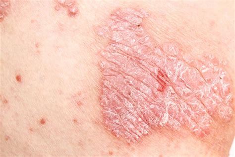 Dermatitis Lesions