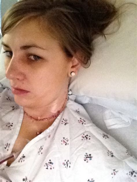 My Experience With Thyroid Cancer Lateral Neck Dissection Surgery