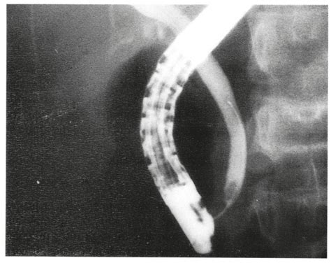 Choledocholithiasis Ercp