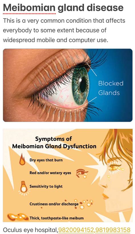 Meibomian Gland Dysfunction And Treatment Welcome To Oculus Eye