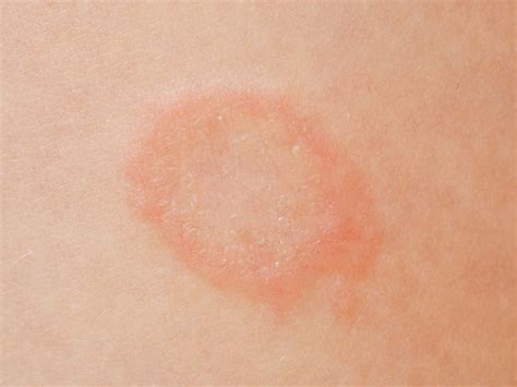 What Does Diabetic Skin Rash Look Like Balmonds