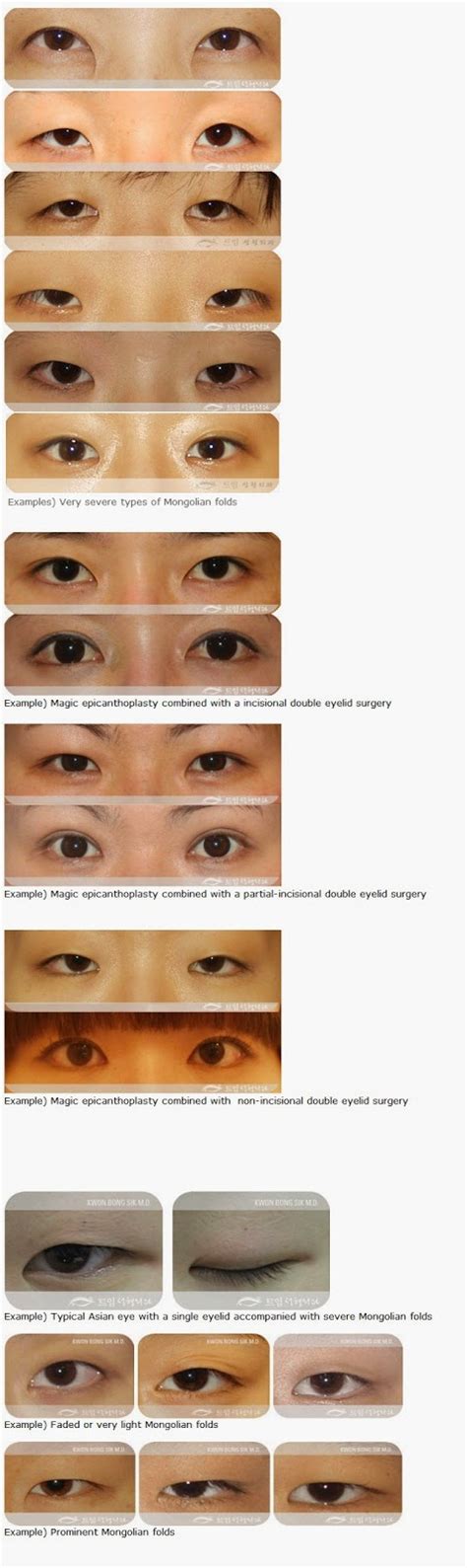 Teuim Aesthetic Plastic Surgical Clinic Drkwon What Is Epicanthal