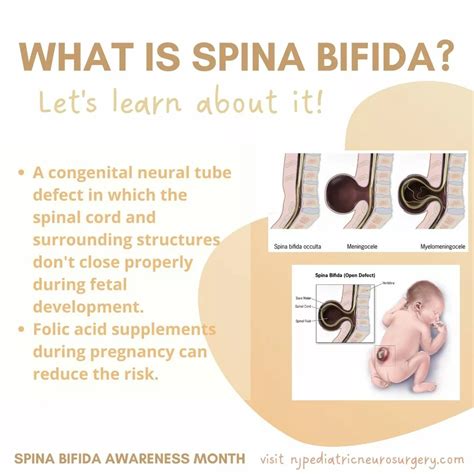 What Is Spina Bifida New Jersey Pediatric Neuroscience Institute