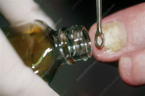 Collecting Fungal Culture From Toenail Stock Image C0430622