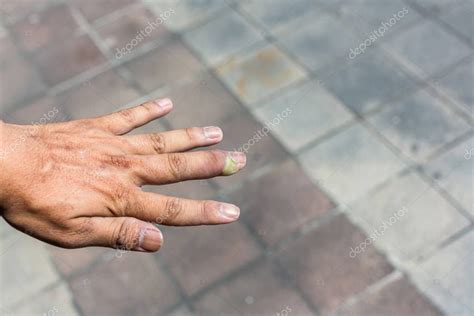 Paroniquia dedo hinchado con inflamación del lecho de las uñas debido