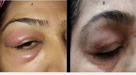 A Diffuse Right Periorbital Swelling With Mild Erythema B