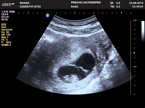 Baby At 8 Weeks Ultrasound All You Need Infos
