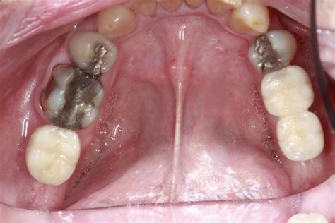 Missing Back Teeth Before And After Pictures