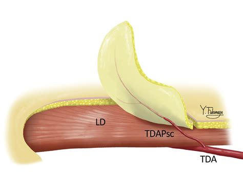 Septocutaneous Thoracodorsal Artery Perforator Flaps A Retrospective