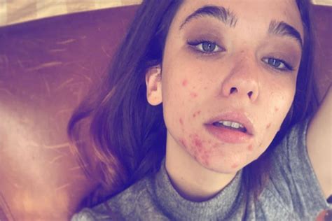 Matilda De Angelis Opens Up About Her Acne On Instagram