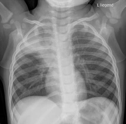 Chest X Ray Of Case Taken On Admission With Partial Atelectasis Of Download Scientific