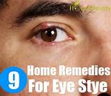 9 Home Remedies For Eye Stye Pictures