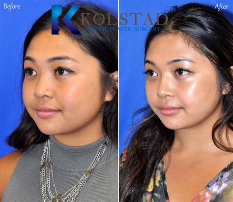 Asian Rhinoplasty Before And After Gallery Dr Kolstad San Diego Facial Plastic Surgeon