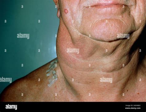 Lymphoma Clinical Photo Of The Neck Of A Patient With A Non Hodgkins