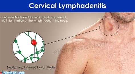 Cervical Lymphadenitis Causes Symptoms And Treatments Global