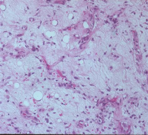 Liposarcoma Myxoid Liposarcoma Soft Tissue Sarcoma Sarcoma Surgeon